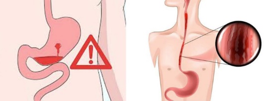 خونريزي گوارشي